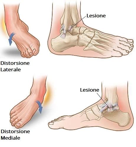 Sport a rischio di distorsione alla caviglia
