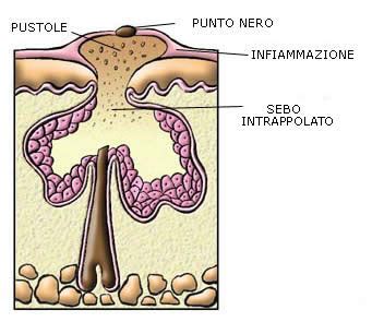 Diagramma del follicolo pilifero con ghiandole sebacee iperattive