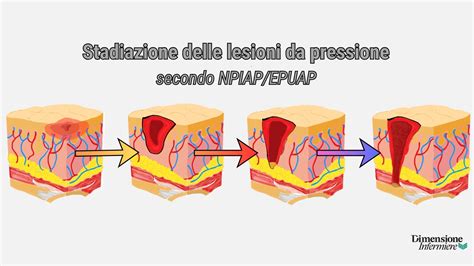 Illustrazione delle tipiche lesioni dell'acne di Maiorca