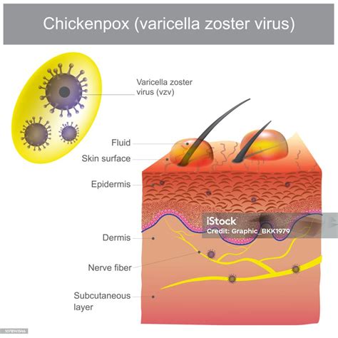 Diagramma del virus varicella-zoster