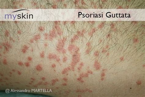 Psoriasi guttata su gambe