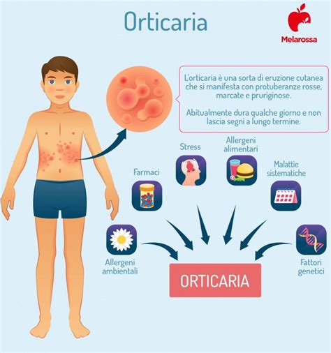Diagramma che illustra le diverse cause di orticaria