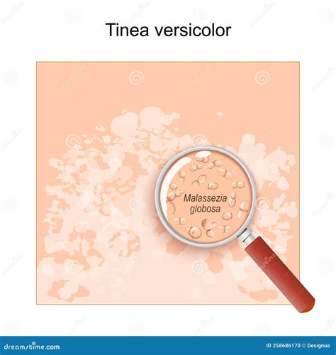 Illustrazione della Malassezia e della sua interazione con la pelle