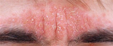 Primo piano di un viso con evidenti segni di dermatite seborroica: rossore e desquamazione