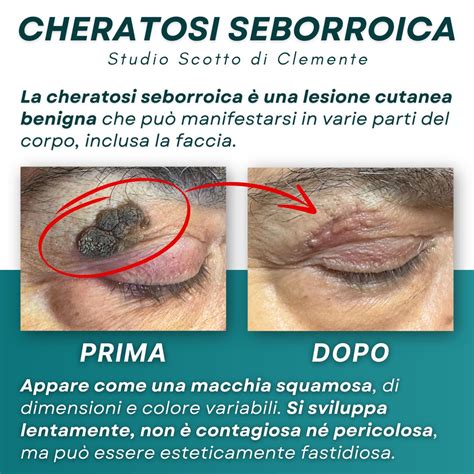 Illustrazione di diverse tipologie di cheratosi seborroica su varie parti del corpo.