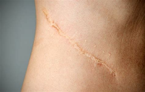 Immagine ravvicinata di una cicatrice iperpigmentata