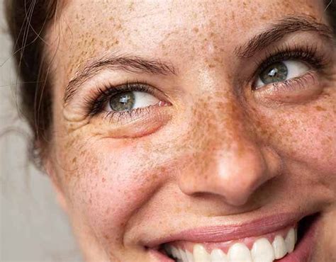 Diagramma che mostra la differenza tra lentiggini ed efelidi