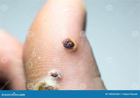 Schema di una verruca con punti neri