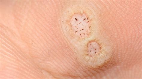 Illustrazione delle diverse tipologie di verruche