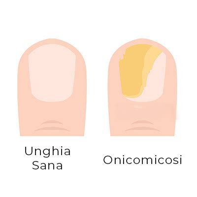 Illustrazione di unghia sana vs unghia con micosi