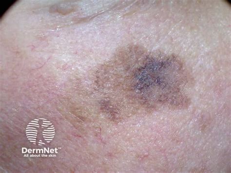 Un'immagine ravvicinata di una lentigo maligna, mostrando i bordi irregolari e la pigmentazione disomogenea.