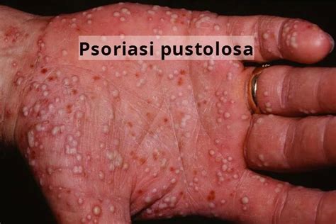 Manifestazione di Psoriasi Pustolosa Generalizzata con pustole sterili su pelle eritematosa