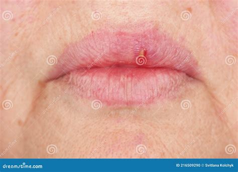 Immagine ravvicinata di vescicole erpetiche sulle labbra