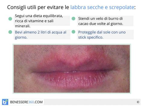 labbra screpolate e secche