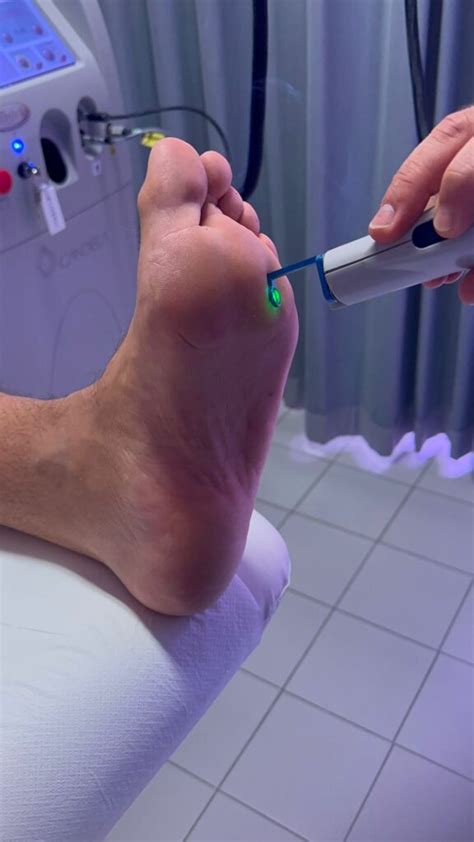 Persona che riceve un trattamento laser per una verruca