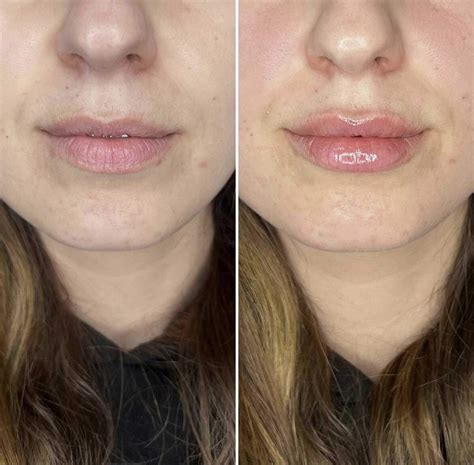 Applicazione di filler alle labbra