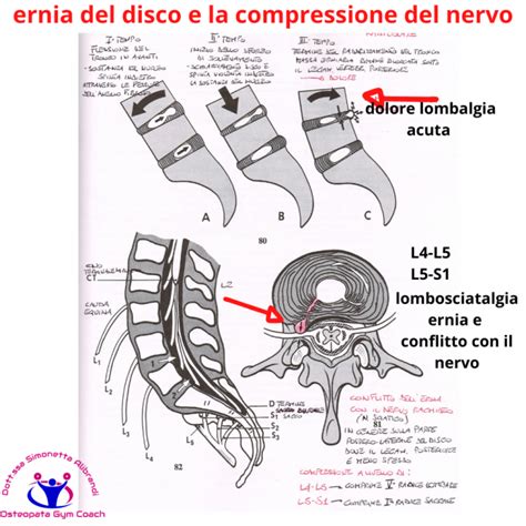 Diagramma di un'ernia del disco che comprime una radice nervosa