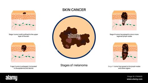 Illustrazione di un melanoma su pelle umana