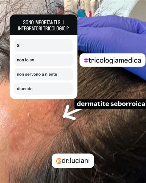 Schema dell'alopecia androgenetica e del ruolo del DHT