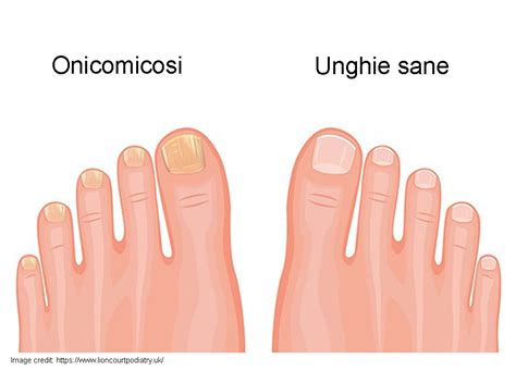 Unghie dei piedi sane e unghie dei piedi infette da onicomicosi a confronto