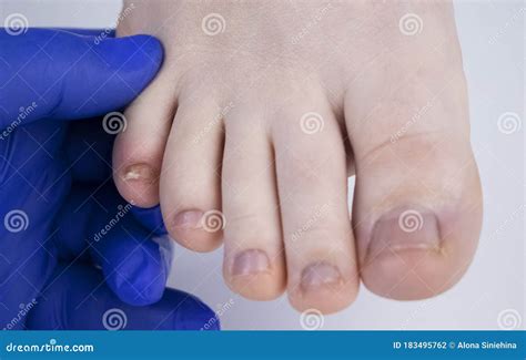 Immagine di piedi curati e sani dopo il trattamento dell'onicomicosi