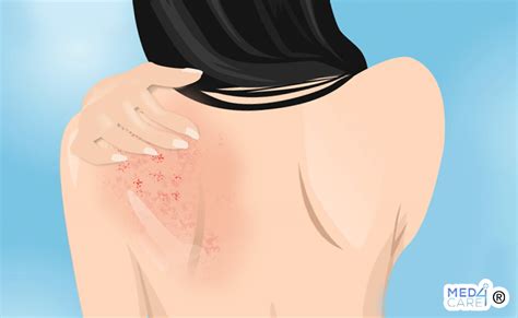 Illustrazione di un rash cutaneo con bollicine rosse