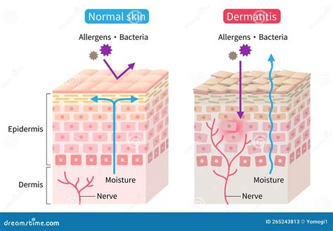 Schema della barriera cutanea danneggiata nella dermatite atopica