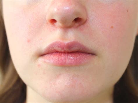 Esempio visivo di dermatite periorale