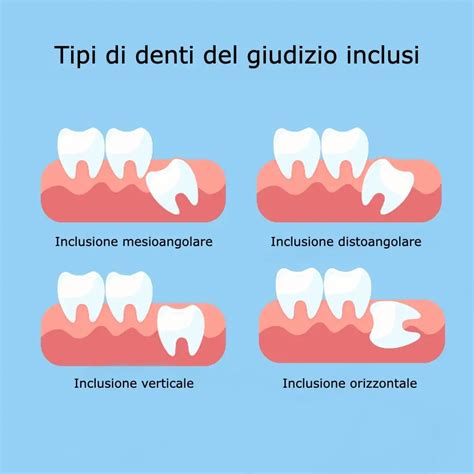 Illustrazione di un dente del giudizio incluso