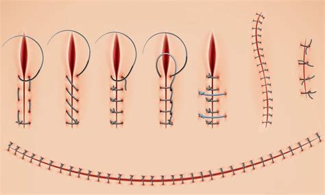 Primo piano di punti di sutura su una gengiva