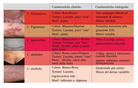 Diagramma delle diverse tipologie di cicatrici: normale, atrofica, ipertrofica, cheloide