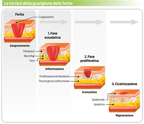 Schema che illustra le diverse fasi del processo di guarigione di una ferita