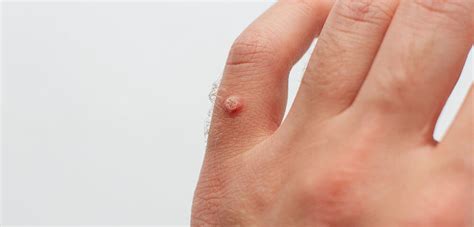 Immagine di una verruca comune sulla mano