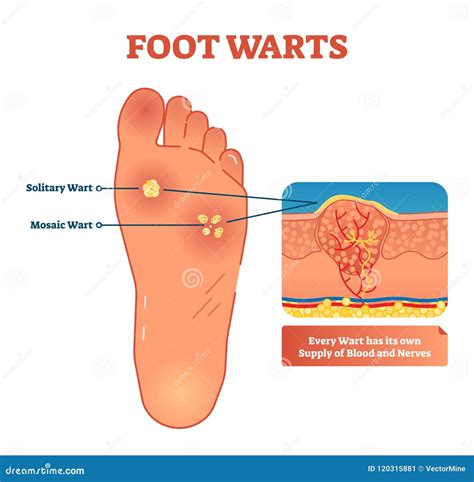 Illustrazione di verruche a mosaico