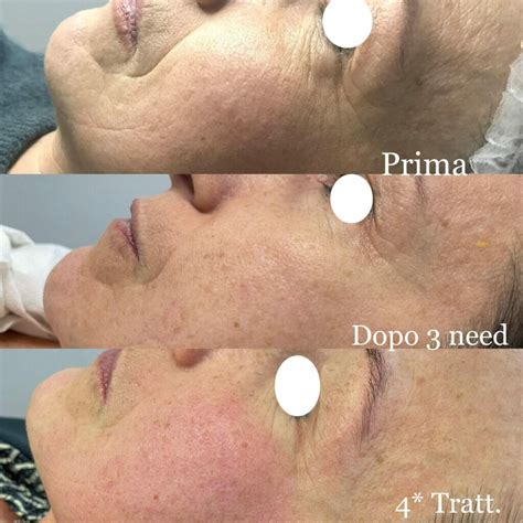 Immagine comparativa prima e dopo il trattamento di microneedling su una cicatrice chirurgica