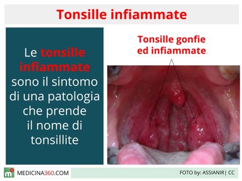 Illustrazione di una gola infiammata con tonsille rosse e gonfie