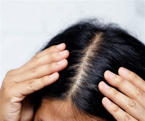 Immagine di una persona che applica correttamente la lozione di minoxidil sul cuoio capelluto