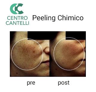 Grafico che illustra la profondità di azione dei peeling chimici