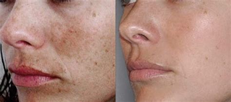 Prima e dopo di un trattamento di peeling chimico con TCA