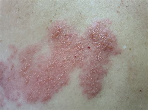 Immagine di un'eruzione cutanea da Herpes Zoster
