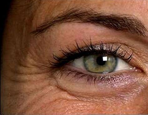 contorno occhi con rughe e occhiaie