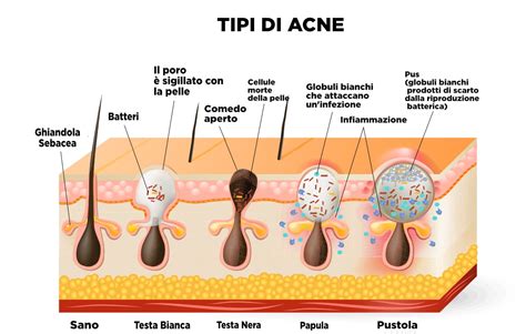 Illustrazione di diversi tipi di lesioni acneiche: brufoli, punti neri, cisti