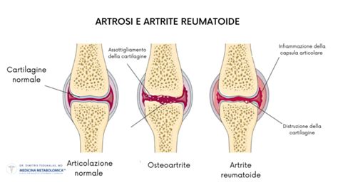 Schema che illustra le differenze tra artralgia e artrite