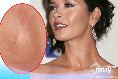 Catherine Zeta Jones con cicatrice sul collo