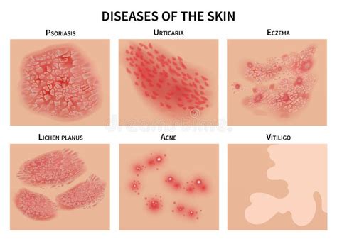 Illustrazione di diversi tipi di eczema sulla pelle