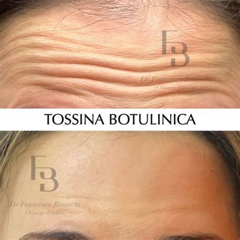 Concetto di muscolo rilassato dalla tossina botulinica