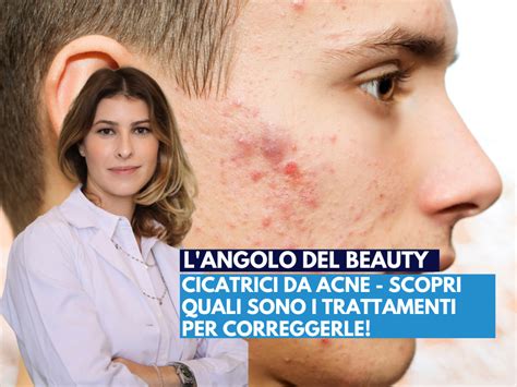 Schema di trattamento per cicatrici da acne