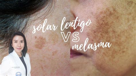 Schema che illustra la differenza tra lentigo senili e melasma