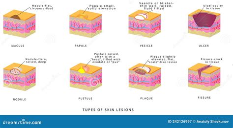 Infografica che illustra i diversi tipi di lesioni cutanee comuni