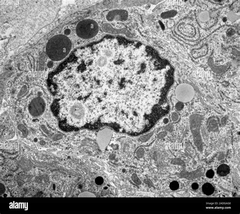 Cellule di melanoma sotto microscopio elettronico